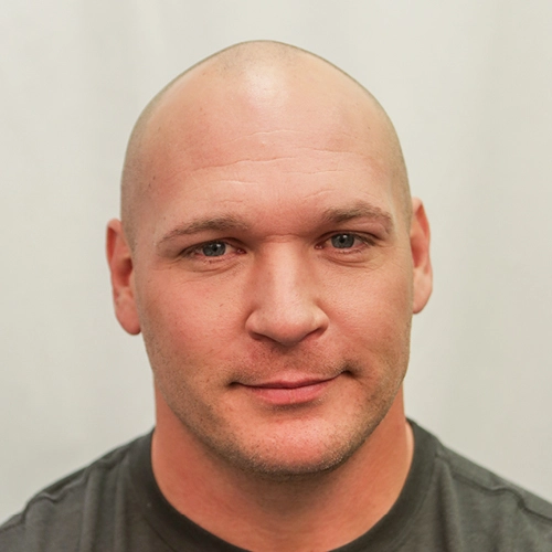 Brian Urlacher before hair transplant