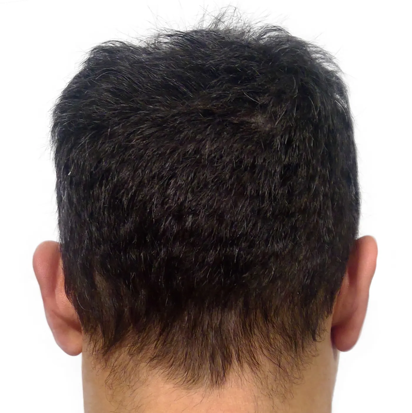 Donor hair before No-Shave FUE