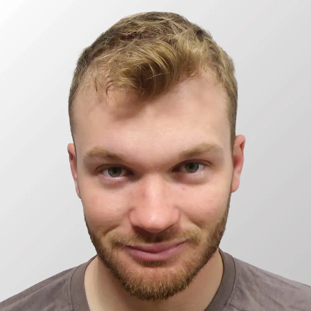 Ian Happ before hair transplant