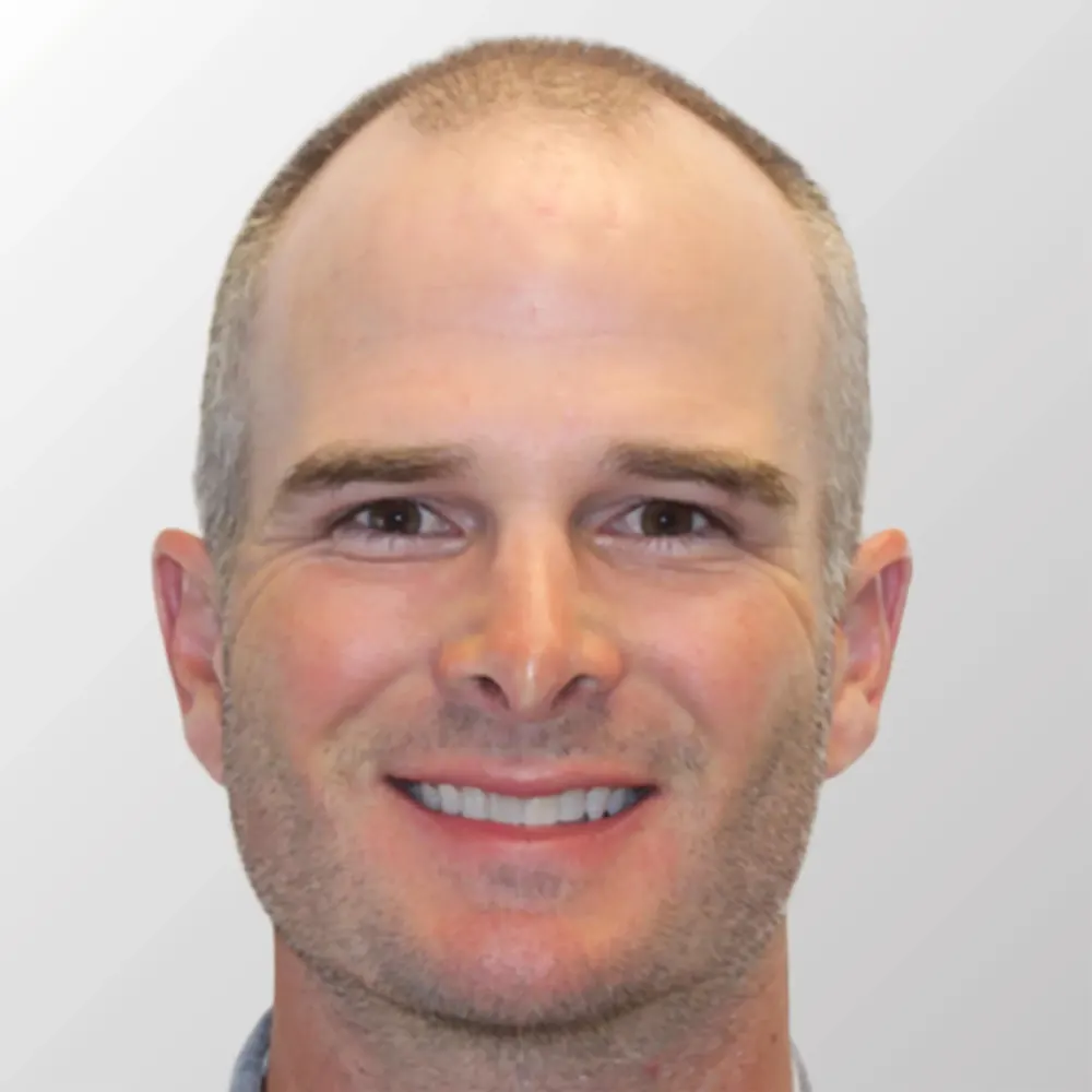 Kevin Streelman before hair transplant