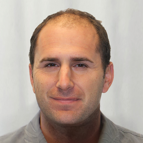 Pat Hoberg before hair transplant