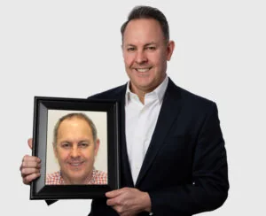 How much does a hair transplant cost?