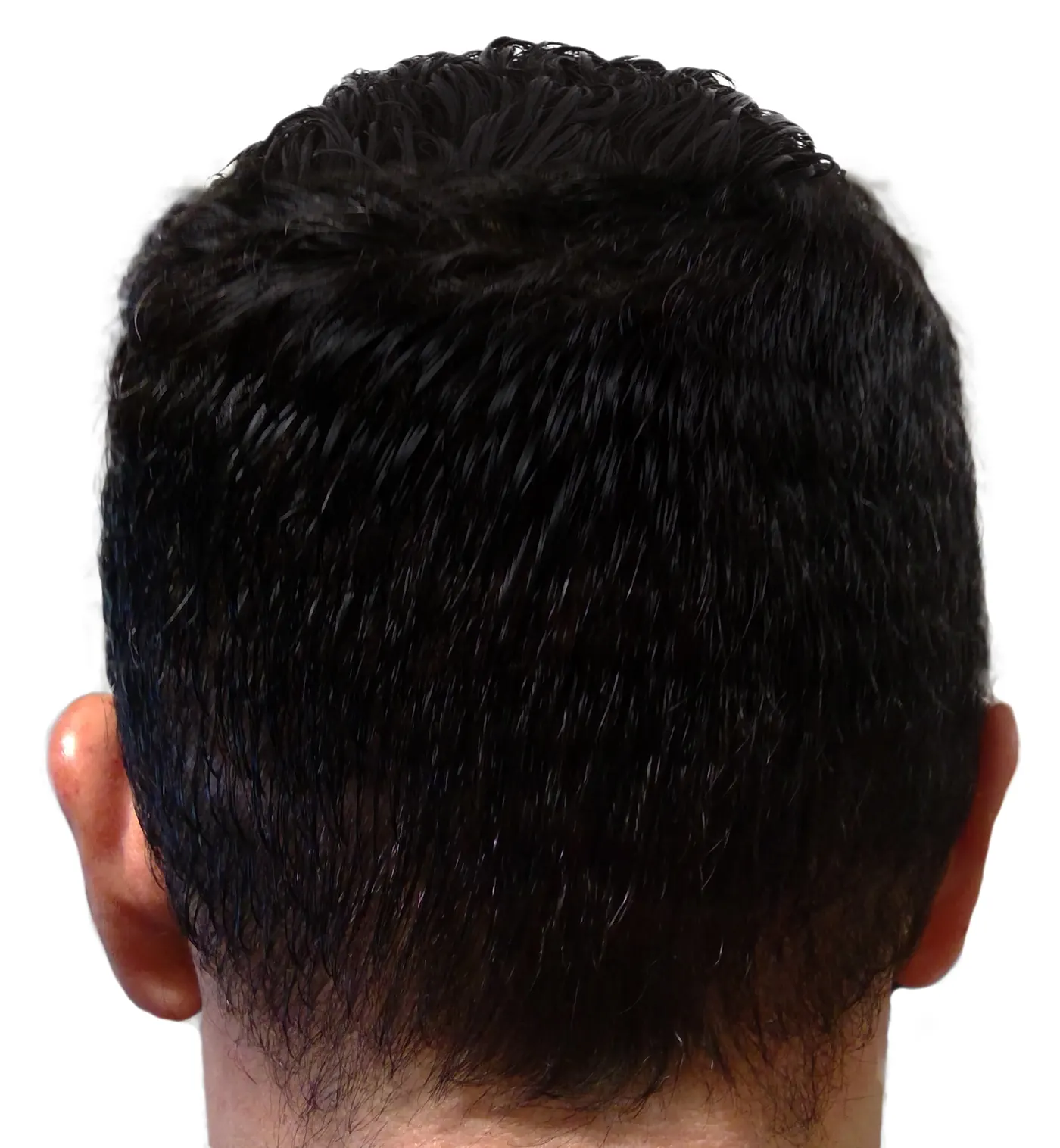 Donor hair after No-Shave FUE