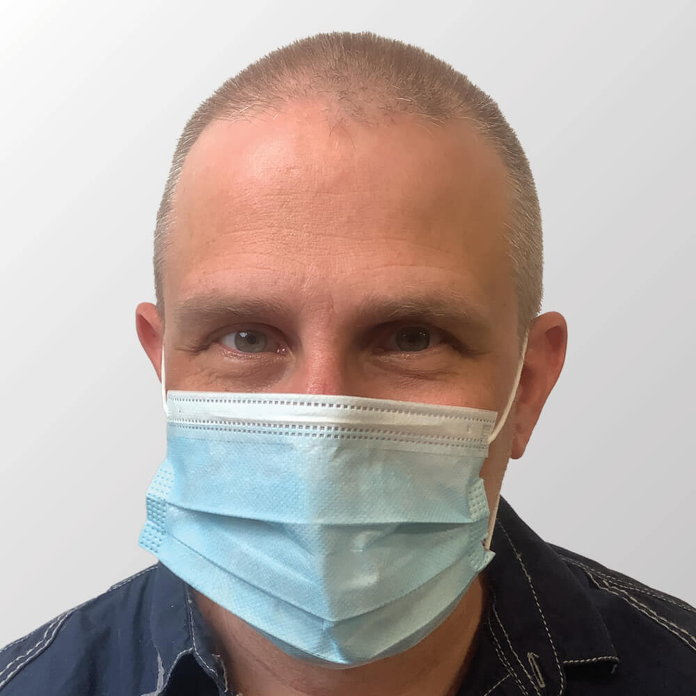 Kevin B. before hair transplant