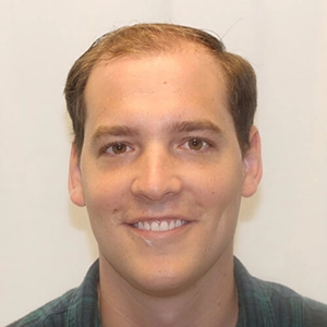 Josh K. before hair transplant