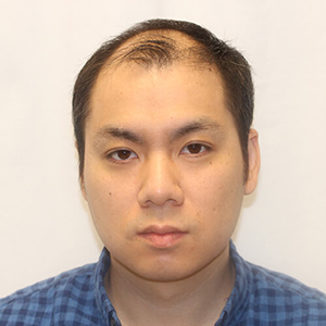 Tony L. before hair transplant