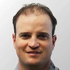 Zach Johnson before hair transplant